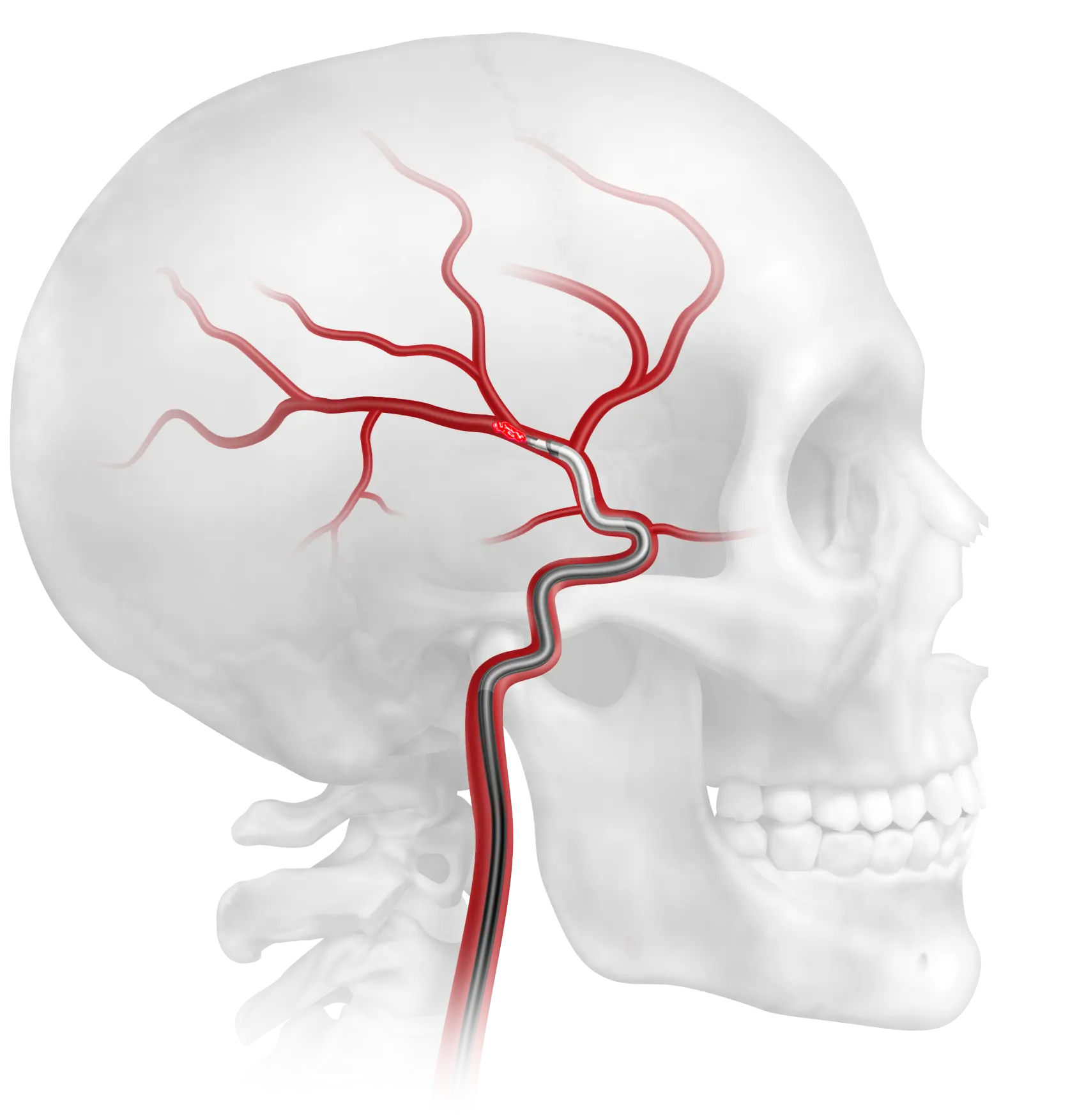 Brain with Clot information tabs