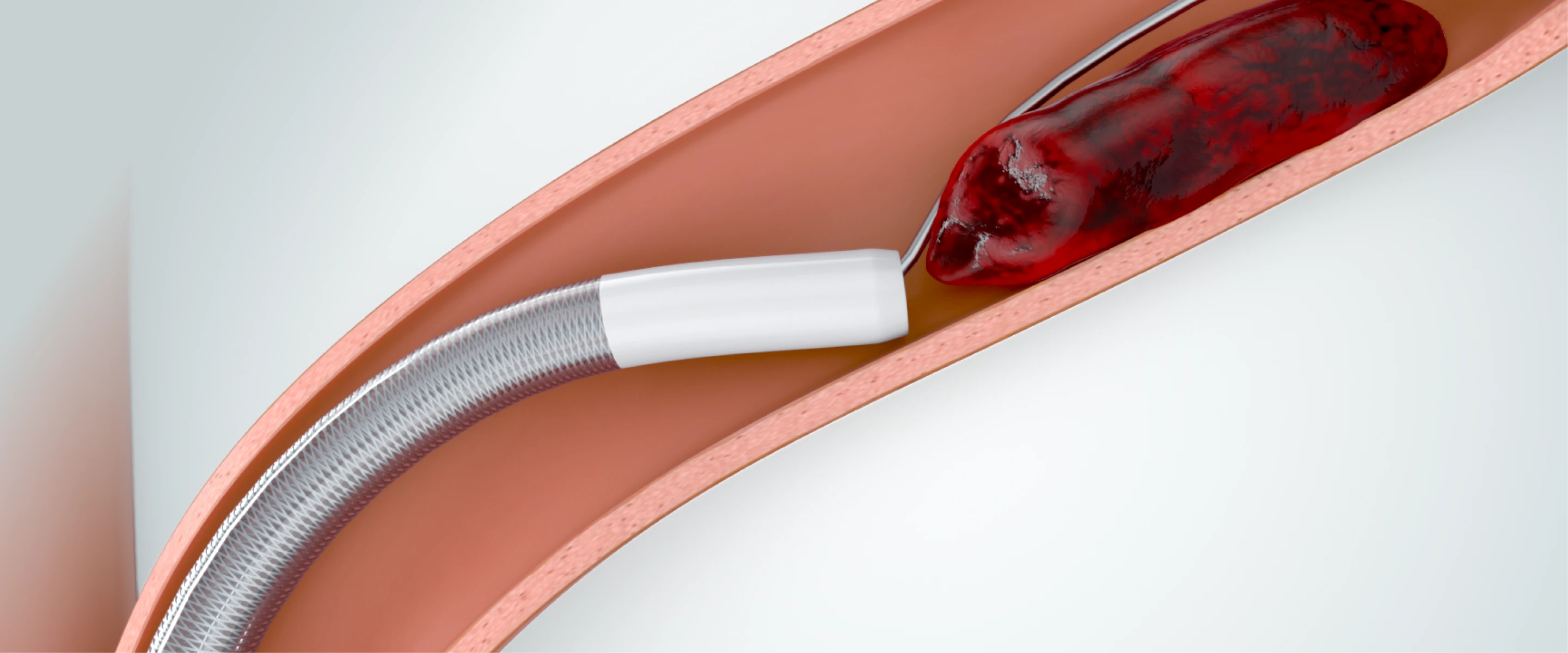 Symphony 16F catheter displayed in a medical context