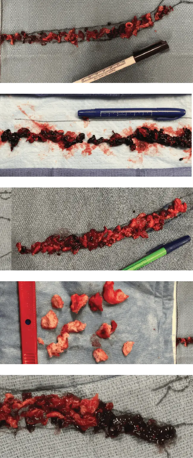 Collection of blood clot images