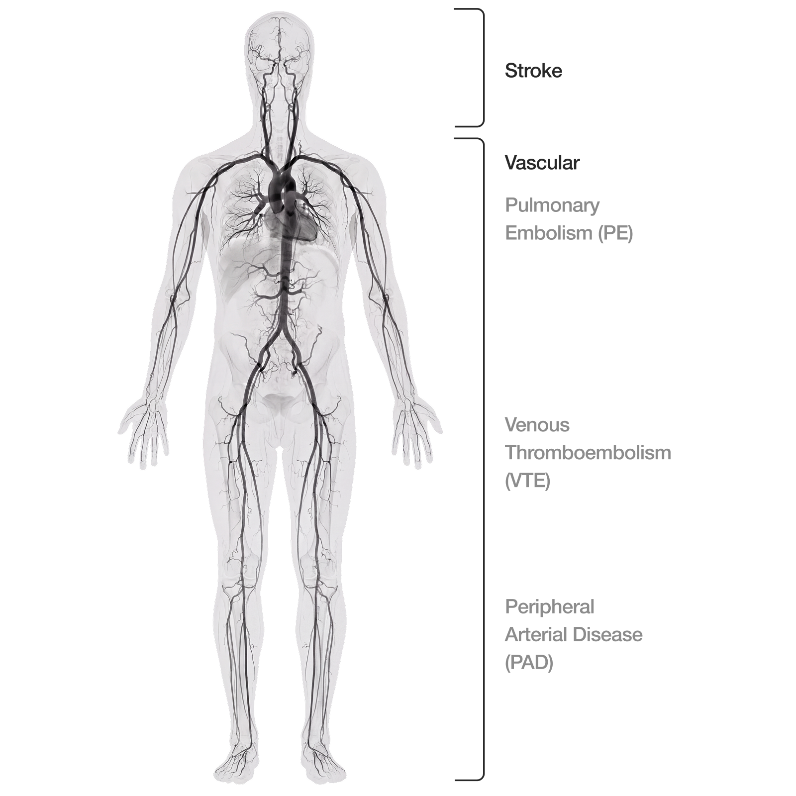 Full-body illustration showing thrombectomy treatment sites from head to toe